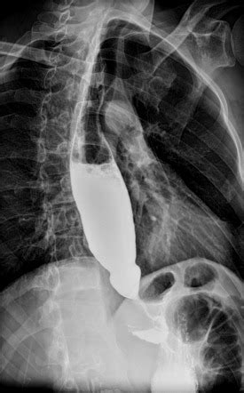 Achalasia Image Radiopaedia Org