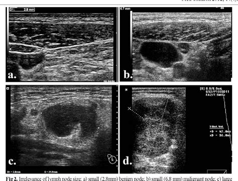 Lymphoma Lymph Nodes Ultrasound