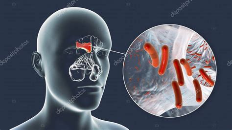 Sinusitis Inflamación De Las Cavidades Paranasales Ilustración 3d Que