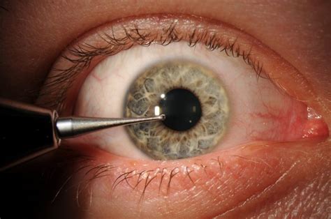 Moran Core Removal Of Superficial Corneal Foreign Bodies