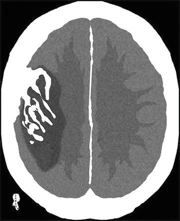 Tomba Dittatura Capsula Cortical Laminar Necrosis Grande Universo