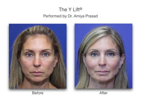 Y Lift Liquid Facelift Results Can Last Anywhere Between Years