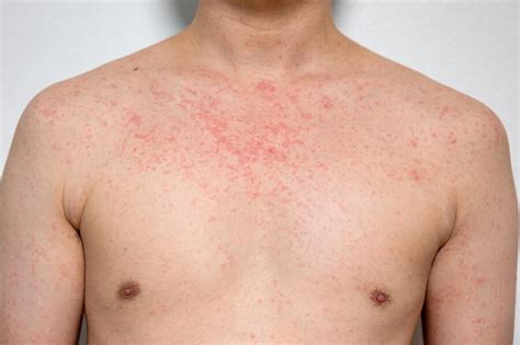 Premium Photo Dermatitis Rash Viral Disease With Immunodeficiency On