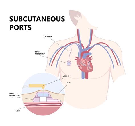 The PowerPort implantable port and catheter device is being linked to ...