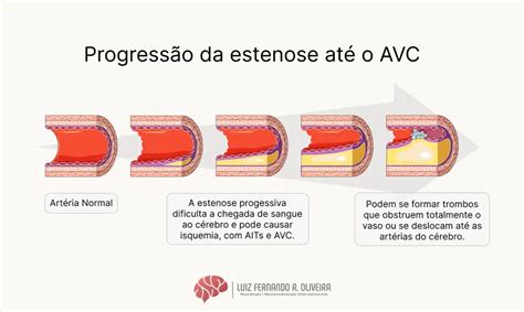 Estenose e Obstrução da Carótida Saiba tudo sobre essa causa de AVC