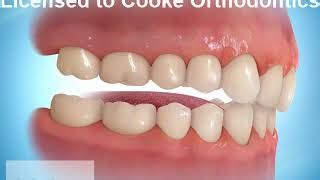 How To Eat With Braces And Bite Blocks Pdf The Use Of Bite Raisers In