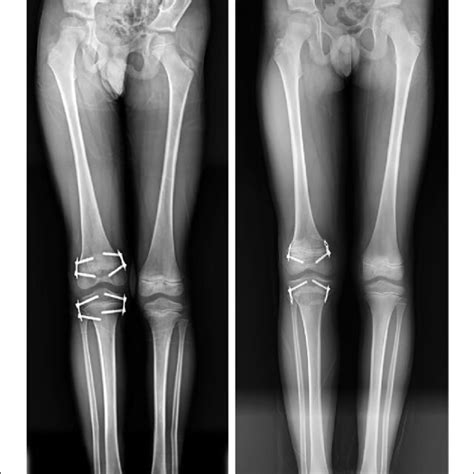 Preoperative X Ray Of A Male Patient With 29 Mm Leg Length Discrepancy Download Scientific