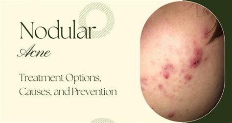 Nodular Acne and Treatment Options: Causes, Prevention