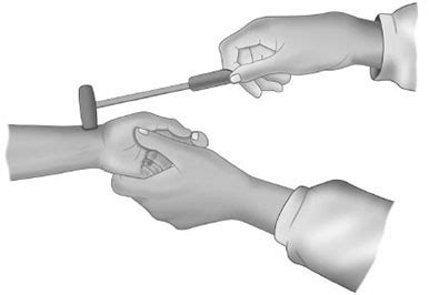 Brachioradialis Reflex