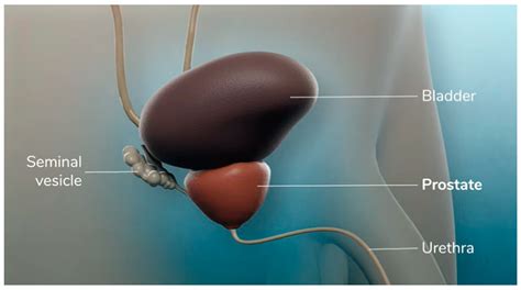 Jpm Free Full Text Video Consensus And Radical Prostatectomy The Way To Chase The Future