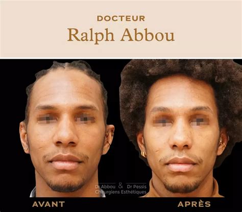 Rhinoplastie ethnique à Paris Dr Ralph ABBOU