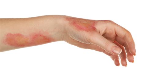 visit  local urgent care   infected burn