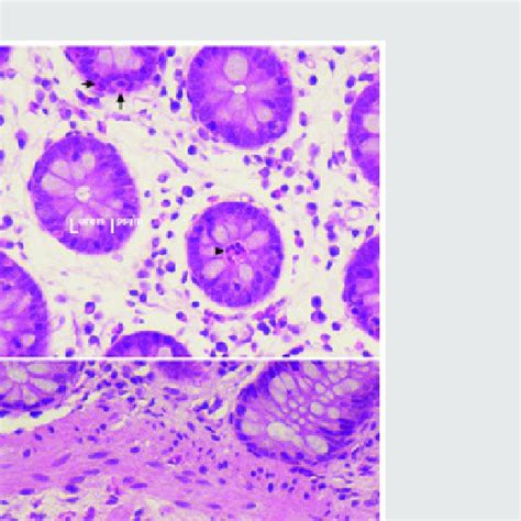 A Eosinophilic Infiltration Of The Lamina Propria Of The Colon Download Scientific Diagram