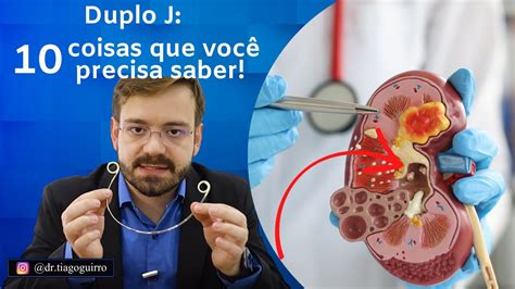 Cateter Duplo J Fatos Importantes Sobre Sua Utiliza O Na Cirurgia