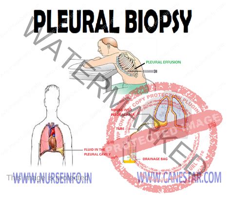 PLEURAL BIOPSY - Nurse Info