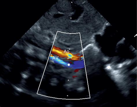 30: Cardiac Malposition and Heterotaxy Syndrome | Veterian Key