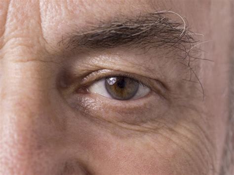 Droopy Upper Eyelid Conditions and Cures | Alpine Eye Care