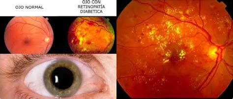 Retinopatía Definición Causas Síntomas Complicaciones y Tratamiento