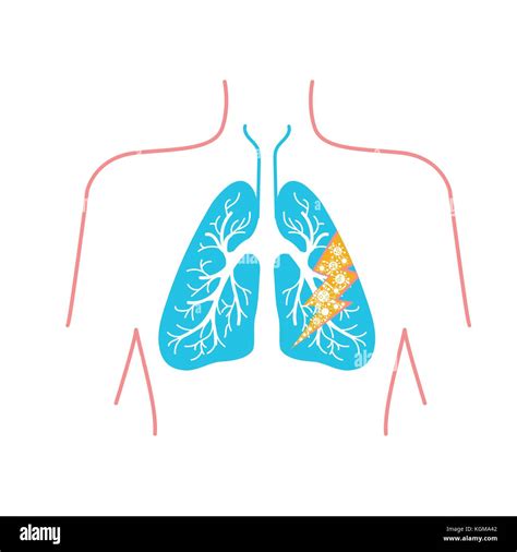 Icon Of Lung Disease Pneumonia Asthma Cancer In The Form Of Lung