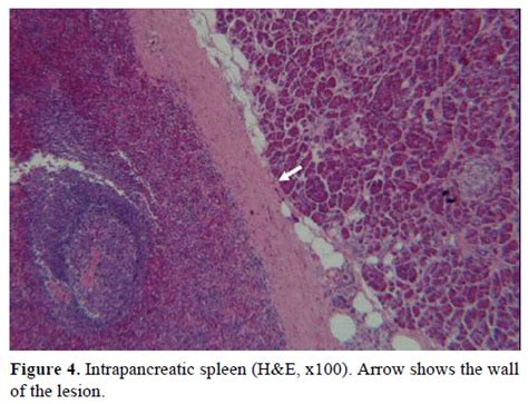 Intrapancreatic Accessory Spleen Issuesdiagnostic And Therapeuti