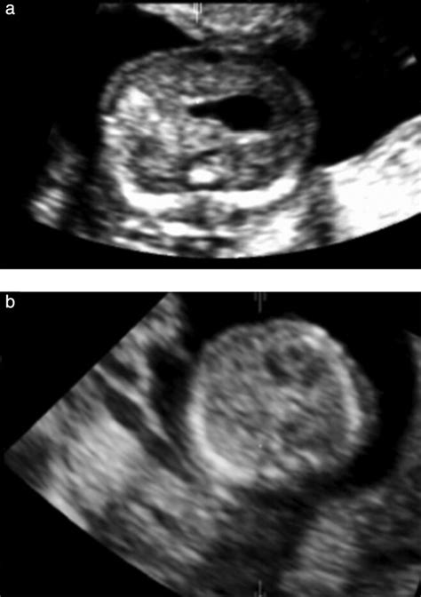 Horizontal Stomach A New Sonographic Clue To The Antenatal Diagnosis