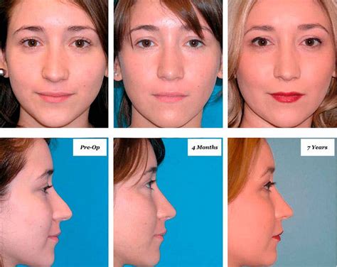 Healing Stages Of Rhinoplasty Richard W Westreich Md Facs