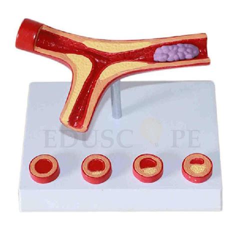 Human Atherosclerosis Cardiovascular Model India Manufacturers