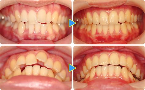 前歯だけ歯並びを治す部分矯正のメリット・デメリット、よくある症例紹介など