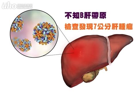 不知b肝帶原 檢查發現7公分肝腫瘤uho優活健康網