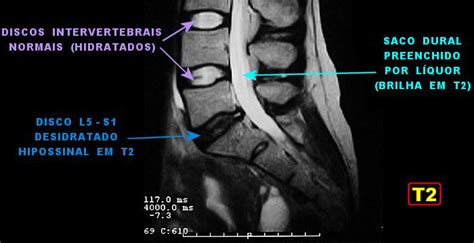 Desidratação Dos Discos Intervertebrais