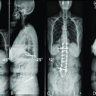 A B Anteroposterior AP And Lateral Standing Radiographs Of A