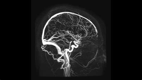 Angiography Flashcards Quizlet