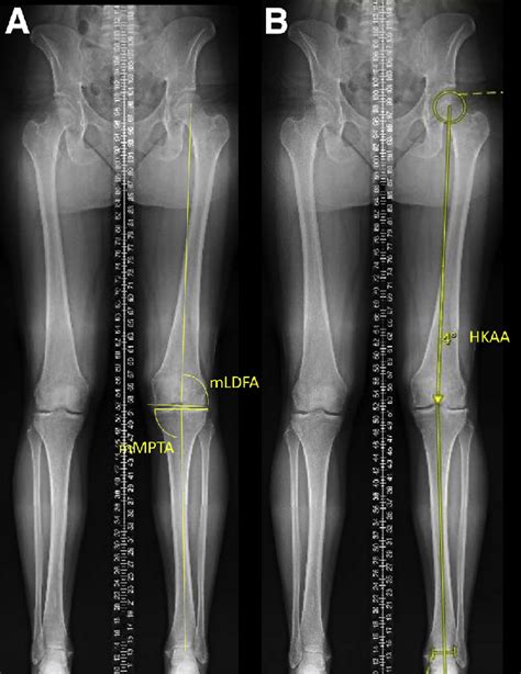 Full Length Standing Anteroposterior Radiographs With Measurements Of