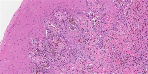 Mucosal melanoma of the oral cavity | Ottawa Atlas of Pathology