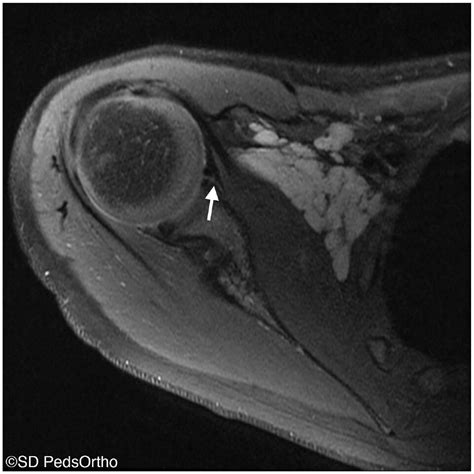 The Buford Complex Redefined A Pathologic Morphology In Sheeps