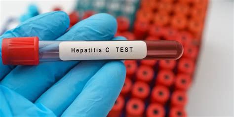 Hepatitis C La Anmat Aprobó Un Test Rápido Para Su Detección Tn