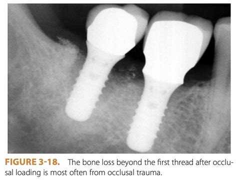 Pain After Dental Implant Crown (Helpful Guide)