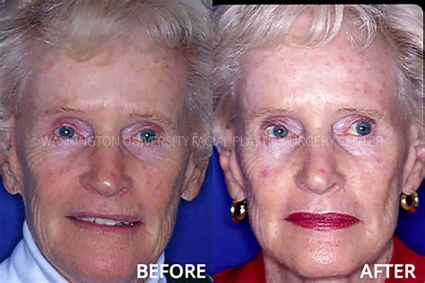 Before And After Facial Plastic Surgery Center Washington