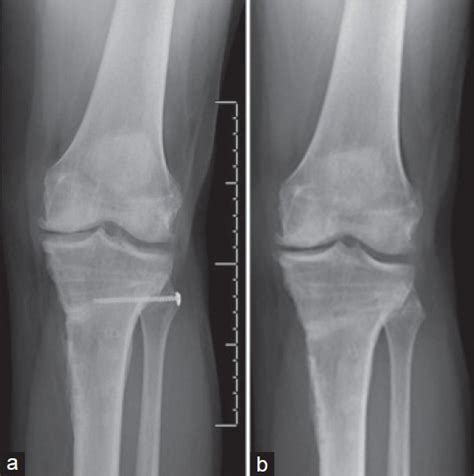 The Radiograph Of Knee Joint Anteroposterior Projection A Showing Download Scientific Diagram