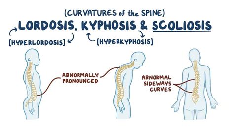 Lordosis, kyphosis, and scoliosis: Video & Anatomy | Osmosis