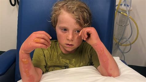 Byron Shire Boy Hospitalised With Margarita Burns After Juicing Limes And Going In The Sun