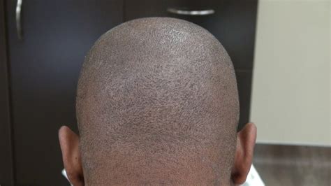 Fue Donor Scar Art Of Hair Transplant On Black Male By Dr Diep Youtube