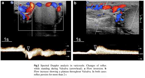 Evaluasi Varicocele Ultrasound Radiologi Id