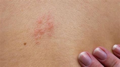 Terkena Herpes Zoster Ini Terapi Yang Bisa Anda Jalani TribunNews