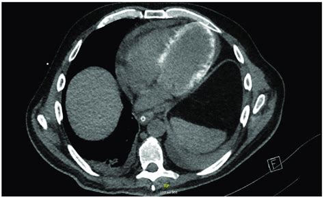 Cardiac Ct Scan With Diffuse Myocardial Calcinations And Pericardial