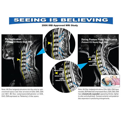 Home Neck Traction Cervical Curve Restoration