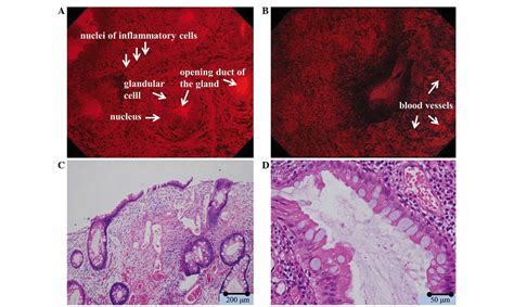 Magnifying Chromoendoscopic And Endocytoscopic Findings Of Juvenile Polyps In The Colon And Rectum