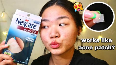 Hydrocolloid Bandage As Acne Patch Youtube