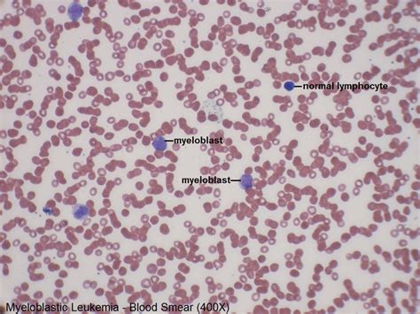 A – Myeloblastic Leukemia – Blood Smear – 400X – 1