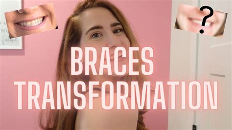 My Journey In Adult Braces Underbite To Overbite Without Surgery